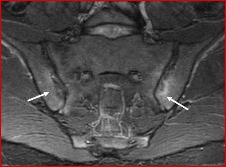 Mri Sacroiliitis