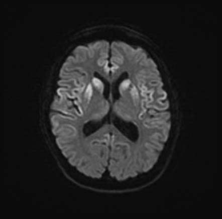 Sporadic Creutzfeld Jakob Disease Radiology Case Radiopaedia Org