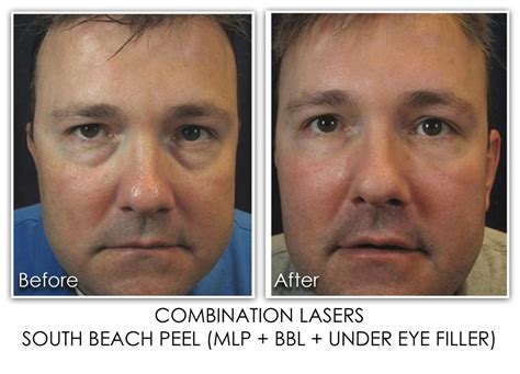 Combination Laser Treatments Skin Rejuvenation Clinic Skin Rejuvenation Clinic