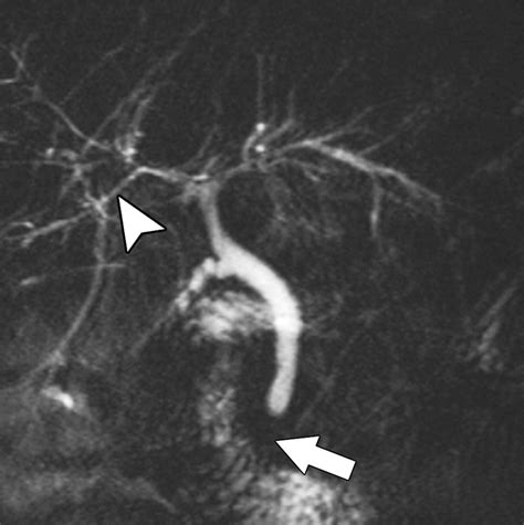 Imaging Features Of Primary Sclerosing Cholangitis From Diagnosis To Liver Transplant Follow Up