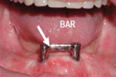 Bar retained implant supported mandibular denture | Download Scientific ...