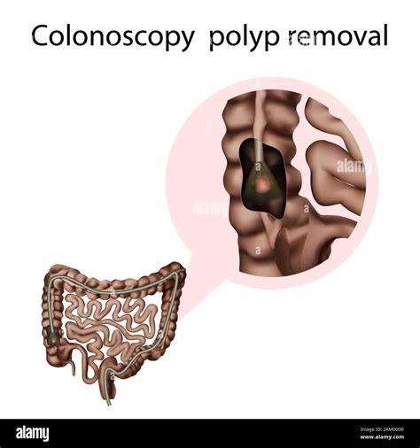 Endoscopia de colon Fotos e Imágenes de stock Página 2 Alamy