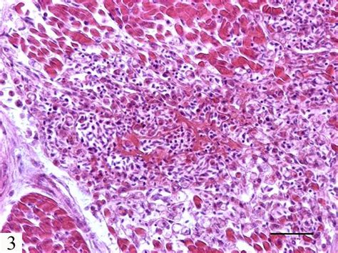 Necrotizing vasculitis (fibrinoid necrosis). Haematoxylin and Eosin ...