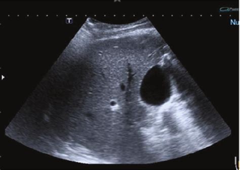 Ultrasound Of Hepatic Doppler Control Showing Changes In Hepatic