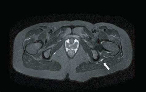 Preoperative And Postoperative Magnetic Resonance Imaging A