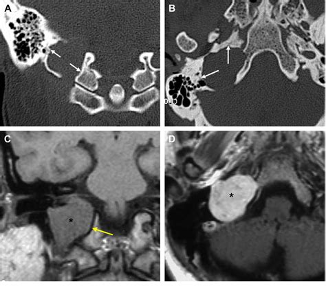 Figure 4 From Imaging Of Jugular Foramen Semantic Scholar