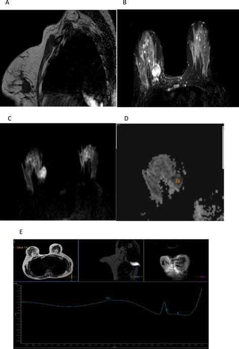 A 45 Years Old Female With Right Breast Mass Proved Histopathologically