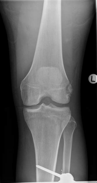 Avulsion Fracture Of Lateral Collateral Ligament Femoral Attachment