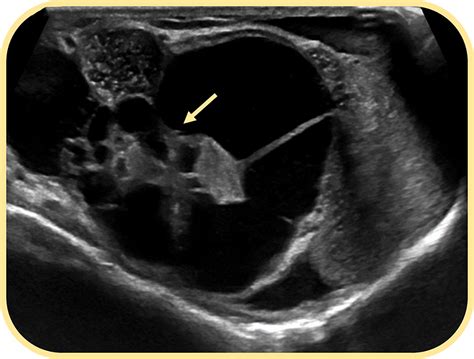 Extratesticular Scrotal Masses And Pseudomasses Radiographics