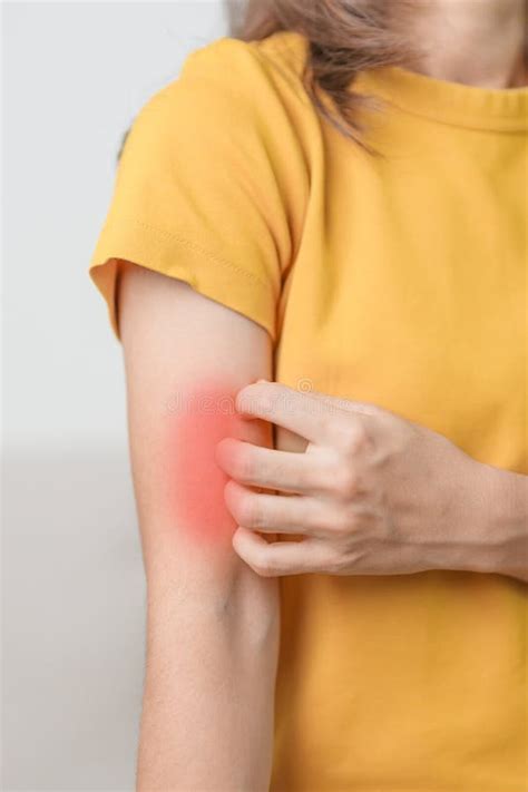 Woman Itching And Scratching Itchy Arm Sensitive Skin Allergic