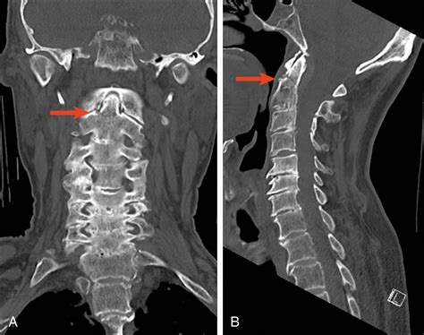 neck pain  syncopal fall clinical tree