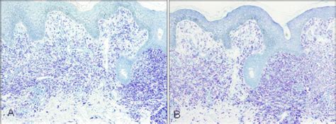 Mast Cells Were Stained With Toluidine Blue A And Giemsa Stains