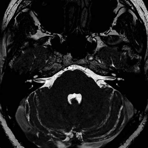 retrocochlear lesion mri