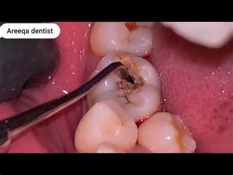 REMOVE FOOD STUCK IN TOOTH HOLE PROCESS SPECIAL DENTIST TEETH