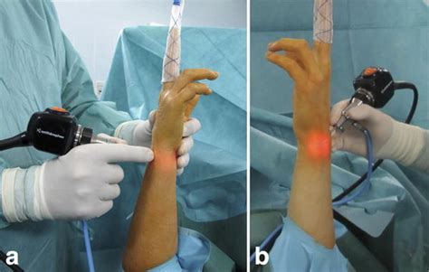 Arthroscopic Wrist Anatomy And Setup Musculoskeletal Key