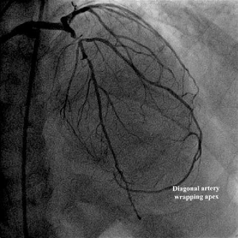 A Coronary Angiographic View Showing 98 Occlusion Of The Left Anterior