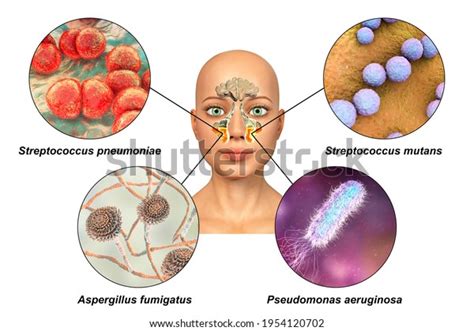 Anatomy Rhinosinusitis Microorganisms That Cause Sinusitis Stock