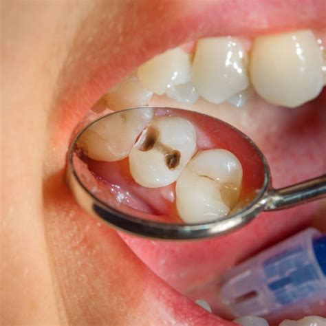 ¿qué Es La Caries Incipiente