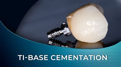 Implant Abutment Cementation Guide Medit Australia The Easy Entry