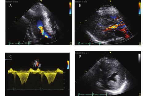 Midventricular Obstructive Hypertrophic Cardiomyopathy In Humans A Download Scientific