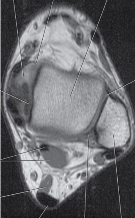 Mri Axial Lt Ankle Diagram Quizlet