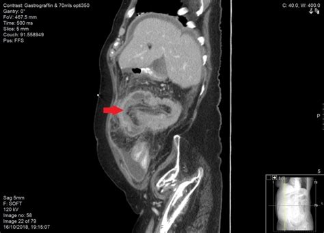 Diagnostic Challenge Of The Non Specific Presentation Of Adult Intussusception Bmj Case Reports