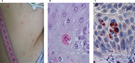 Toxoplasmosis Rash