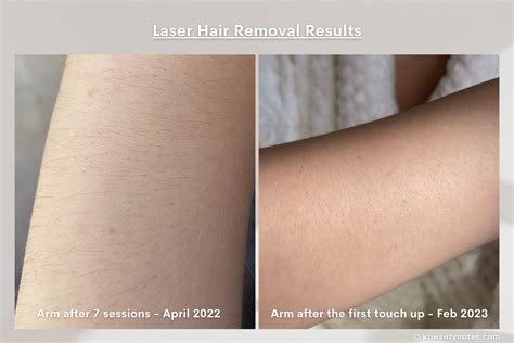 My Experience With Total Body Laser Hair Removal Before And After