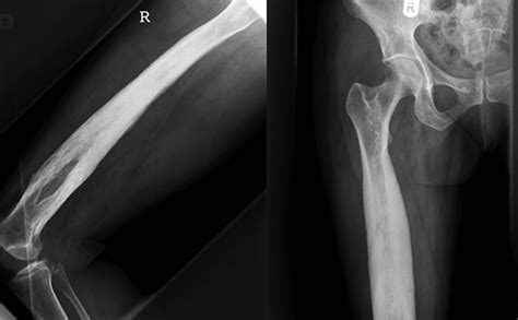 Sclerosing Osteomyelitis Of Garré Management Of Femoral Pain By Intramedullary Nailing Bmj