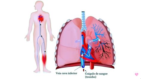 O Que Embolia Pulmonar Enfermagem Florence