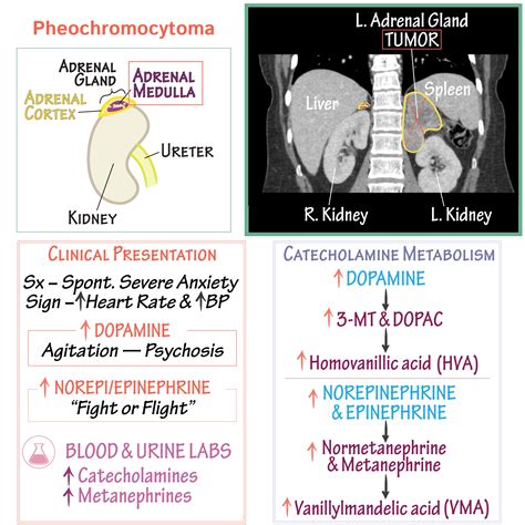 Clinical Pathology Glossary Pheochromocytoma Ditki Medical And Biological Sciences