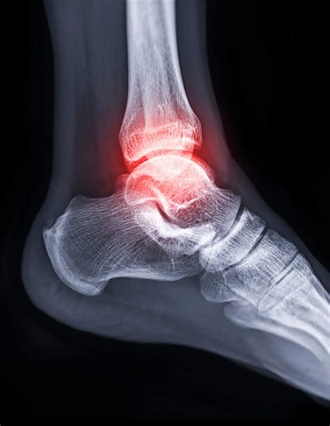 Ankle Surgery for McKinney, TX | Sports City USA Foot & Ankle Center ...