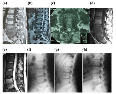 Discitis At L4 L5 Level Following Fenestration And Discectomy Of 33