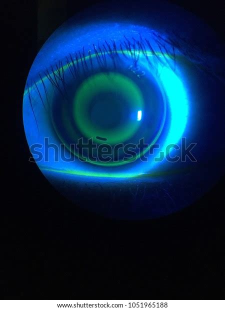 Orthokeratology Contact Lens Fitting Stock Photo (Edit Now) 1051965188