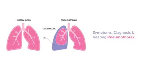 Pneumothorax Symptoms Causes And More