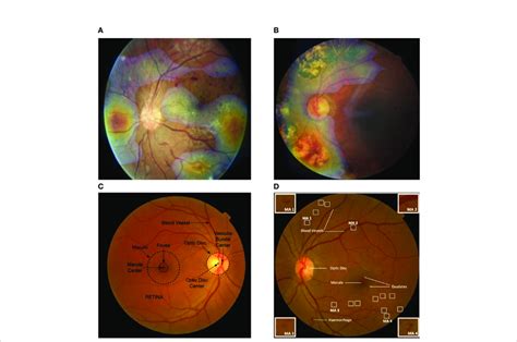 Visualization Features Generated Automatically From Color Fundus