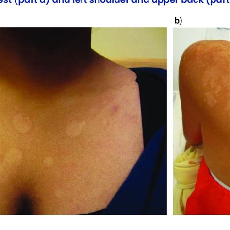 Pdf Tinea Versicolor An Updated Review