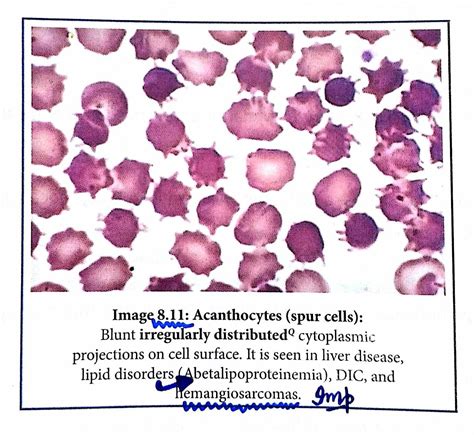 Acanthocytes / Spurr cell causes ... #Liver disease | Hematology, Liver ...