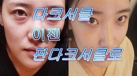 다크서클수술 2 주후까지 총정리 Youtube