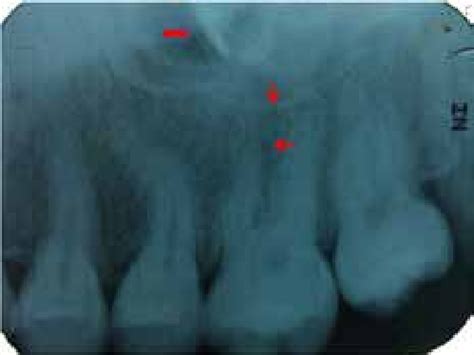 Intra Oral Periapical Radiograph Showing Widened Periodontal Ligament