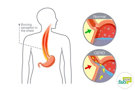 Feel The Burn Heres What You Can Do About It North Country Hospital