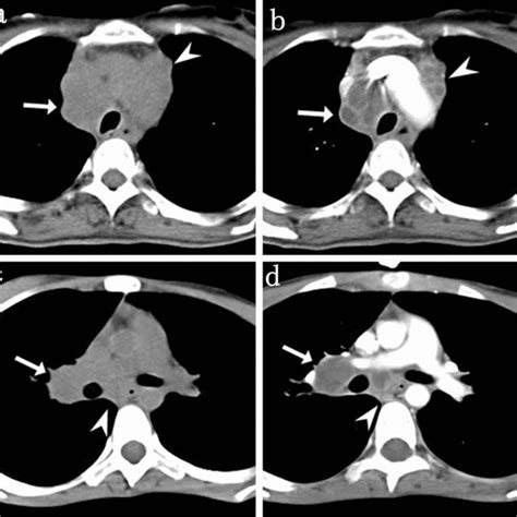 Mediastinal Enlarged Lymph Nodes With Calcification In Tb And Silicosis Download Scientific