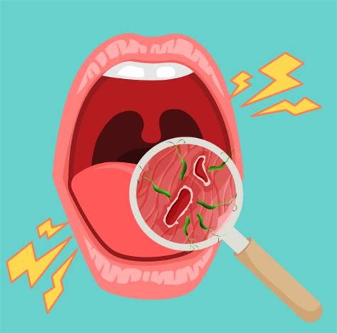 What Does Mouth Ulcer Look Like Infoupdate Org