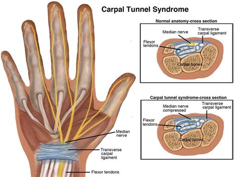 Median Nerve Carpal Tunnel