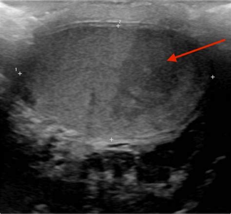 Scrotal Pain Caused By A Segmental Testicular Infarct The Western