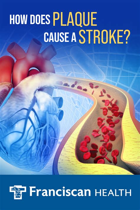 How Does Plaque Cause A Stroke? | Franciscan Health