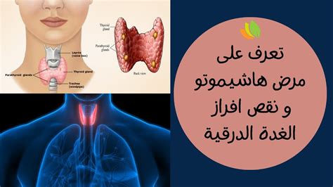 مرض هاشيموتو و نقص افراز الغدة الدرقية تعرف على مرض هاشيموتو و مشكلة