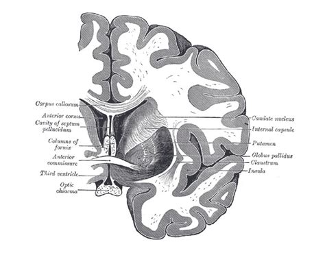 Radiology Mri Anterior Commissure