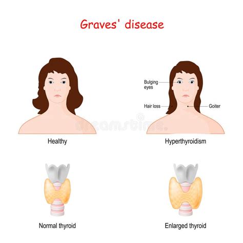 Hyperthyroidism Symptoms Stock Illustrations 81 Hyperthyroidism