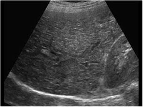 Abdomen and retroperitoneum | 1.1 Liver : Case 1.1.16 Miscellaneous ...